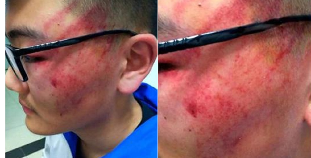 Δάσκαλος χτύπησε τόσο δυνατά μαθητή που άφησε το αποτύπωμα της παλάμης του πάνω του