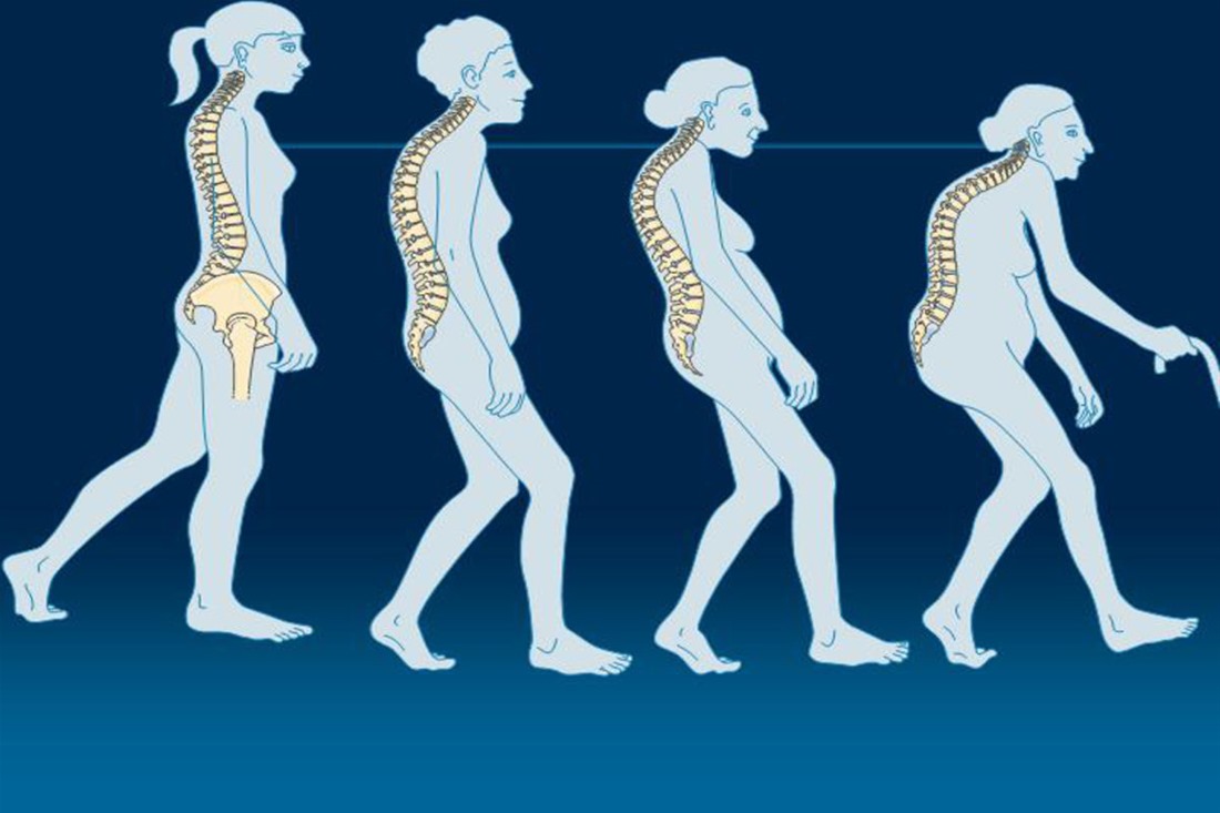 Δωρεάν προληπτικοί έλεγχοι οστεοπόρωσης στην Κατερίνη