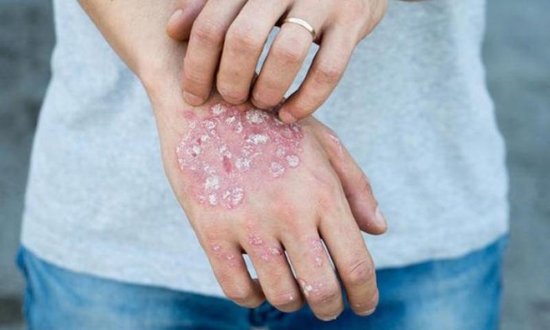 Πανδημία: Έξαρση της ψωρίασης προκαλεί το στρες του κορωνοϊού