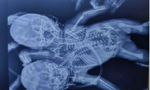 Ινδία: Γεννήθηκε μωρό με δύο κεφάλια, τρία χέρια και δύο καρδιές