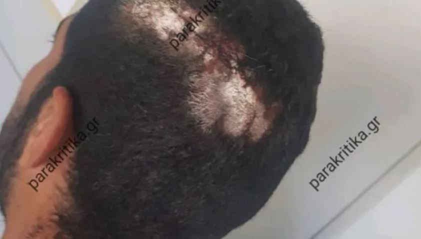 Χανιά: Ζήτησε από τον εργοδότη τα λεφτά του και εκείνος τον… έσπασε στο ξύλο