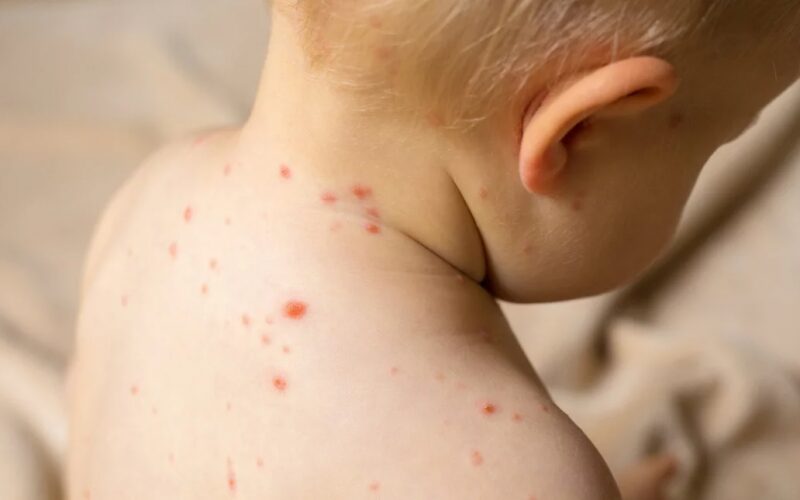 Συναγερμός για τον κίνδυνο επιδημίας ιλαράς – Τα μέτρα από τον ΕΟΔΥ